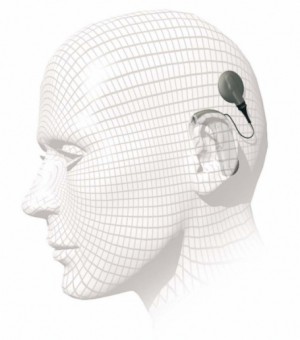 Traditionelt cochlear implantat uden på hovedet. Foto: Arkiv.